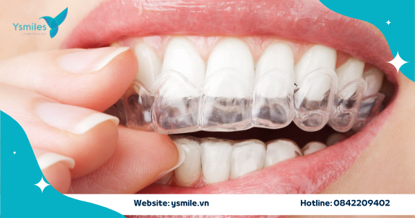 Nắn Chỉnh Răng Bằng Khay Niềng Trong Suốt