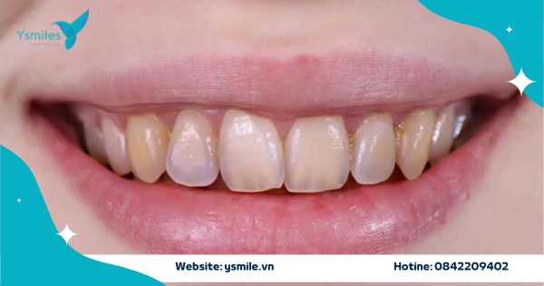 Phục Hồi Và Bảo Tồn Men Răng