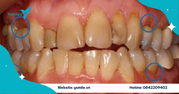 Trám Cổ Răng Khuyết