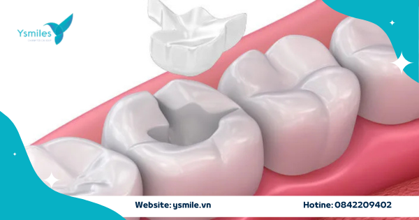 Trám Răng Inlay