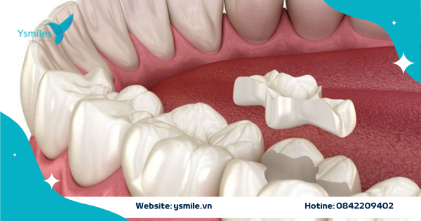 Trám Răng Onlay