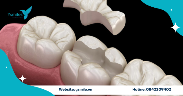 Trám Răng Overlay