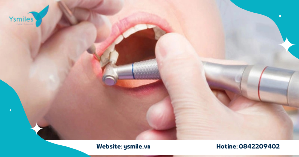 Vệ Sinh Răng Tổng Quát