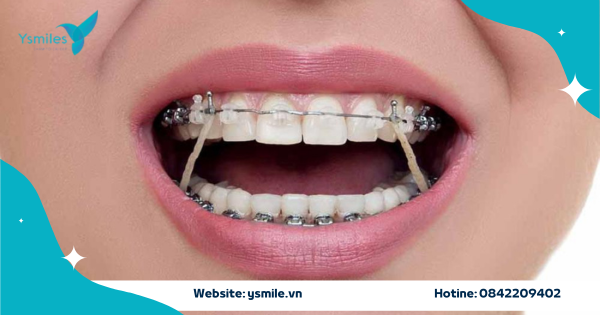 Dịch Vụ Chỉnh Nha