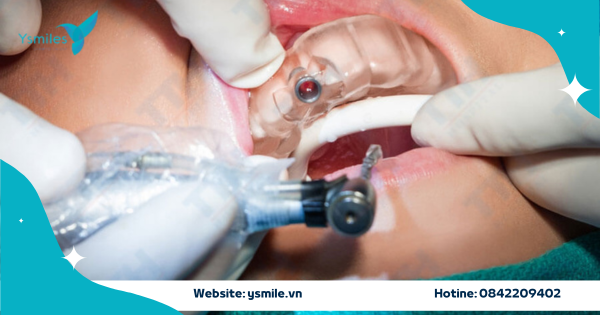 Trồng Răng Implant